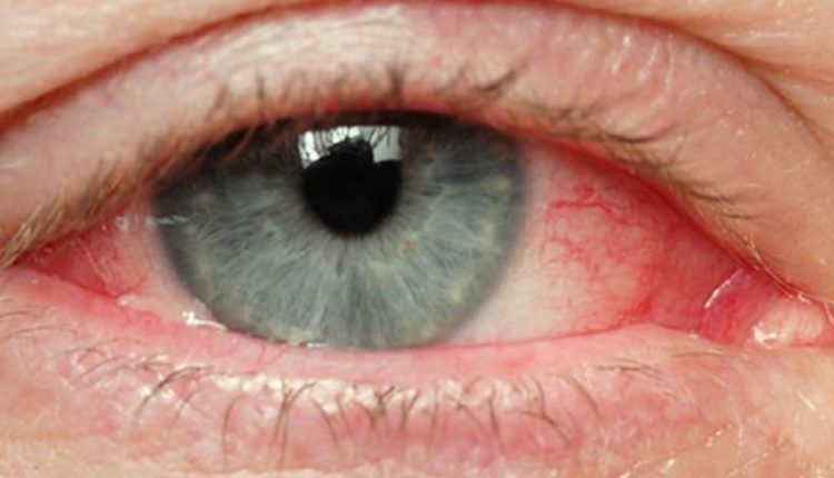 eye-ulcers-and-how-to-treat-them